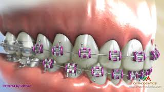 Orthodontic Braces  Different Parts 2 [upl. by Marybelle518]