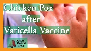 Chicken Pox after Varicella Vaccine  Auburn Medical Group [upl. by Medea]