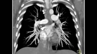 Lung Anatomy Pulmonary Embolism VRT [upl. by Razatlab]