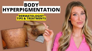 Dermatologist Explains Body Hyperpigmentation What Causes It Best Treatments Prevention amp More [upl. by Ylsew]