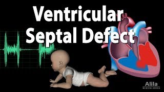 Ventricular Septal Defect Animation [upl. by Aihsilef]