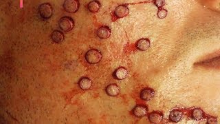 Black Head Face Trypophobia Acne What is it Plus Multivitamin [upl. by Airotnes]