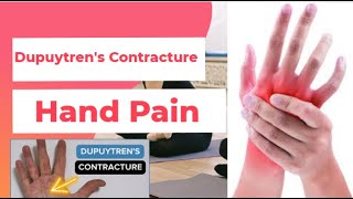 Dupuytrens Contracture  Hand Pain  PhysiotherapyKnowledge [upl. by Esinaej]