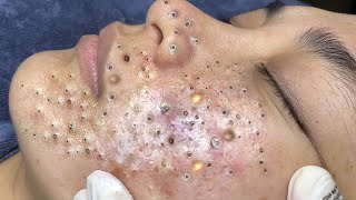 blackheads lipsl Acne treatment l Extraction cysts and blackheads l blackheads lips [upl. by Neelya11]