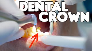 Dental Crown Procedure EXPLAINED [upl. by Llechtim234]