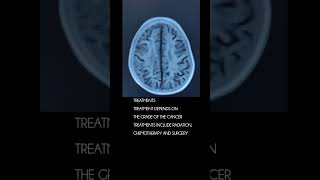 Glioblastoma cancer [upl. by Akirdna]