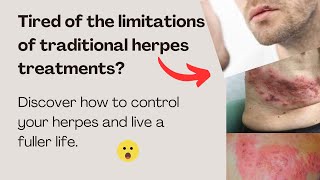 Natural supplements Herpes Relief Solution [upl. by Stilu951]