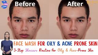 Face wash for oily and acne prone skin skincare skincareroutine acnetreatment oilyskin serum [upl. by Terrill]