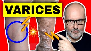 VARICES en las PIERNAS causas síntomas y tratamiento [upl. by Weidner605]