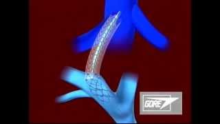 Endoprosthesis  Transjugular Intrahepatic Portosystemic Shunt TIPS [upl. by Schwing]