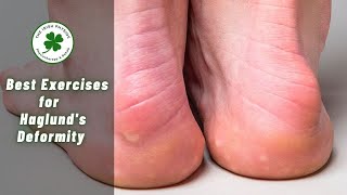 Best Exercises for Haglunds Deformity by Physical Therapists [upl. by Northway33]