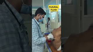 PLEURAL FLUID  Drain tb cancer drsatyampathak doctor medicotips pleuralfluid lungs cough [upl. by Paver347]