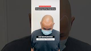 Scalp Micropigmentation Results Session 1 smp scalpmicropigmentation smptraining [upl. by Notneuq630]