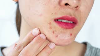 Uncover the Truth Behind Skin Spots Petechiae [upl. by Wandis]