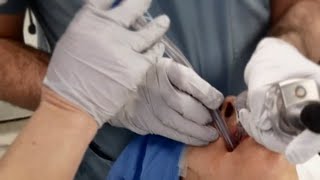 Understanding Placement of Double Lumen Endotracheal Tube [upl. by Arlan163]