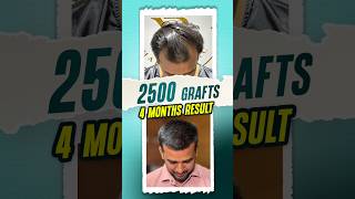 2500 Grafts Hair Transplant  4 Months Result hairtransplant hair shorts ytshorts [upl. by Nollaf]