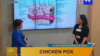 Good Morning Kuya Chicken Pox  Symptoms and Treatment [upl. by Waki]