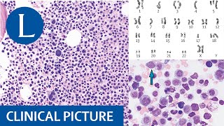 Acute myeloid leukaemia and cytogenetic and molecular abnormalities [upl. by Morrison]