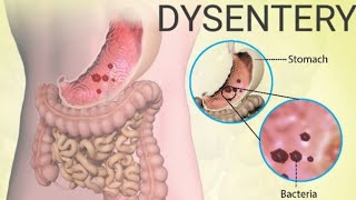 What is Dysentery Bacillary dysentery Amoebic dysentery DysenterysymptomsDiagnosis Treatment [upl. by Lemaceon928]