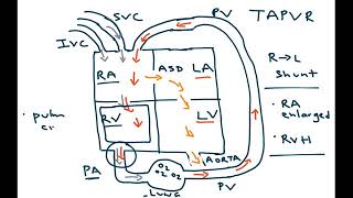 Total Anomalous Pulmonary Venous Return TAPVR [upl. by Osnola]