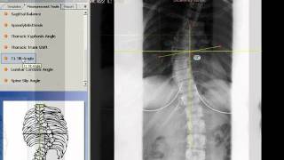 TraumaCad  T1 Tilt Angle [upl. by Dyol963]