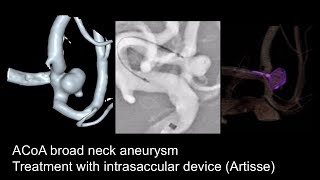 Aneurysm ACoa  Artisse [upl. by Ahsaele]