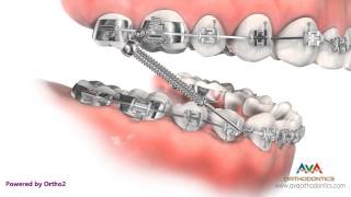 Orthodontic Treatment for Overjet Overbite  Forsus Appliance [upl. by Tanny]