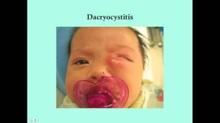 Dacryocystitis  CRASH Medical Review Series [upl. by Taka]