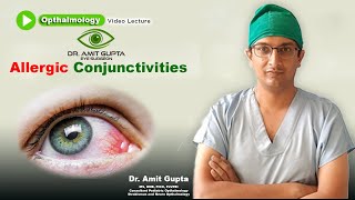 Allergic conjunctivitis  Ophthalmology  Signs and Symptoms  Diagnosis and Treatment [upl. by Oraneg]