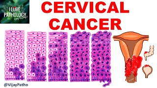 Squamous Intraepithelial lesion amp CANCER CERVIX [upl. by Gilletta826]