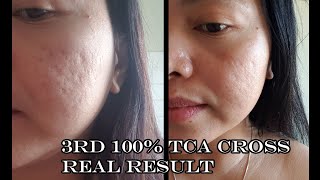 3rd 100 TCA Cross DIY At HomeReal ResultBelleLife Tv [upl. by Downe38]