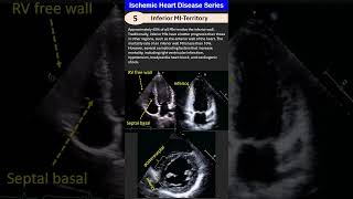 Ischemic Heart Disease 5 Inferior MI [upl. by Enelloc]