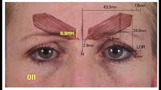 Indepth Guide To Treating The GlabellaForehead With Botox  Dr Chris Hutton [upl. by Anertac]