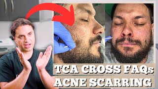 What Is TCA  TCA Cross For Acne Scarring  Dr Solomon Explains Everything You need To Know [upl. by Asiuol]