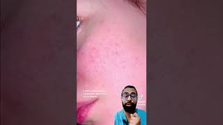 What is Tretinoin Doctor explains [upl. by Otrebliw]