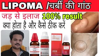 LIPOMA Homeopathic treatment लिपोमा का जड़ से इलाज होम्योपैथिक के दवा से best treatment of lipoma [upl. by Ellatsirhc358]