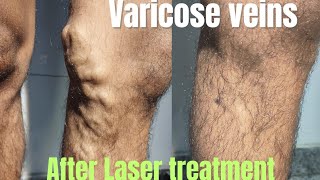 Amazing result of varicose veins treatment Laser treatment of varicose veins Varicose treatment [upl. by Eta]