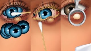 ASMR Removal Of Big Eye Infection  Eye infection With Eye Lenses Lailagamingj4r [upl. by Xuaegram447]