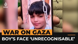 Injured Palestinian boy in Gaza no longer recognises his own face  Al Jazeera NewsFeed [upl. by Lipcombe]