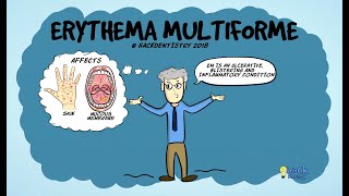 Erythema multiforme [upl. by Rosemare839]