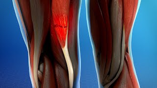 Hamstring Muscle Injuries [upl. by Par]