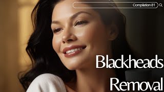 Skincare  Blackheads Removal 081 skincare skincare blackheads blackheads [upl. by Tabbitha]