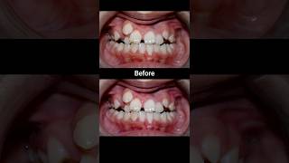 20 months Braces Transformation braces dentist orthodontist dental [upl. by Neyr]