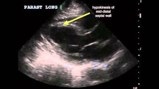 Apical ischemia [upl. by Mena]