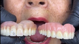 PRÓTESIS DENTAL FLEXIBLE O ACRILICA  🤔🤔 viral odontologia fypシ [upl. by Bright404]