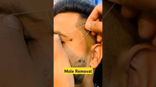 How to remove a mole moles moleremoval shorts drniveditadadu [upl. by Okimuk]