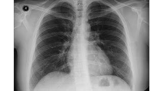 Chest xray  Asbestosis  Pleural calcifications  Round atelectasis [upl. by Elleyoj]