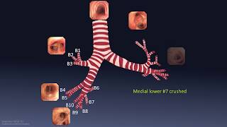 Mastering Bronchoscopy for Thoracic Surgery Chapter 1 [upl. by Idid]