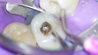 Root Canal Retreatment with Post Removal Endodontic Retreatment [upl. by Grounds]