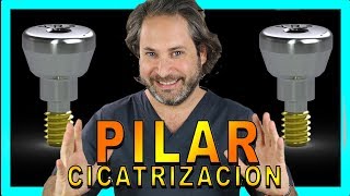 👉PILAR de CICATRIZACION IMPLANTES♦️SEGUNDA FASE Implantes DENTALES funcion♦️ [upl. by Clein]